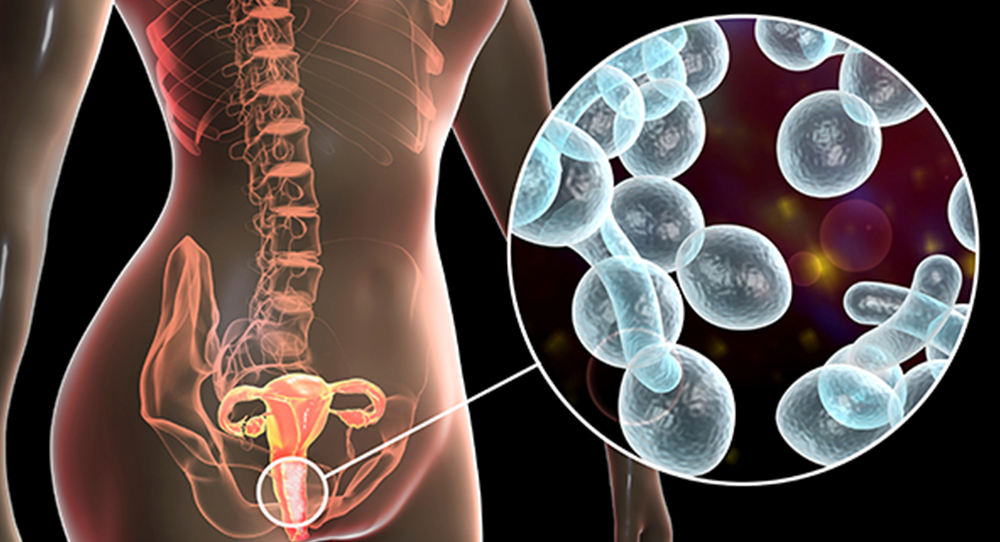 Candidosis vulvovaginal recurrente